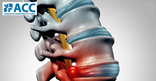 Bệnh thoát vị đĩa đệm có nguy hiểm không?