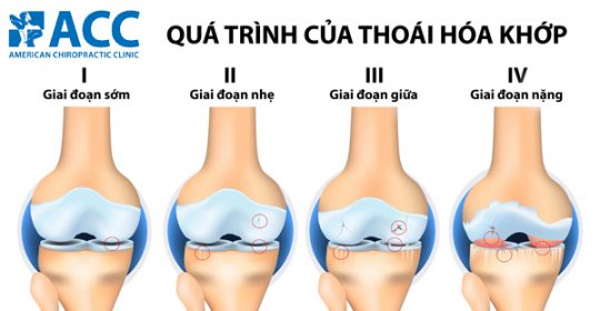 Những điều bạn nên biết về viêm khớp gối và biện pháp chữa trị