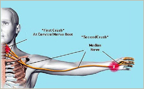 ACC English | Wrist pain