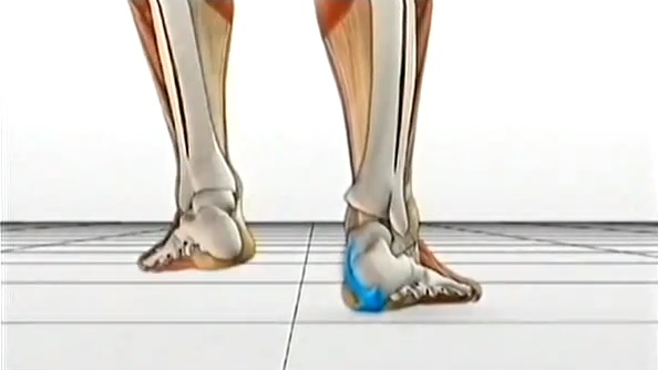 Flat Feet and Treatment