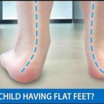 flat foot in children 2019