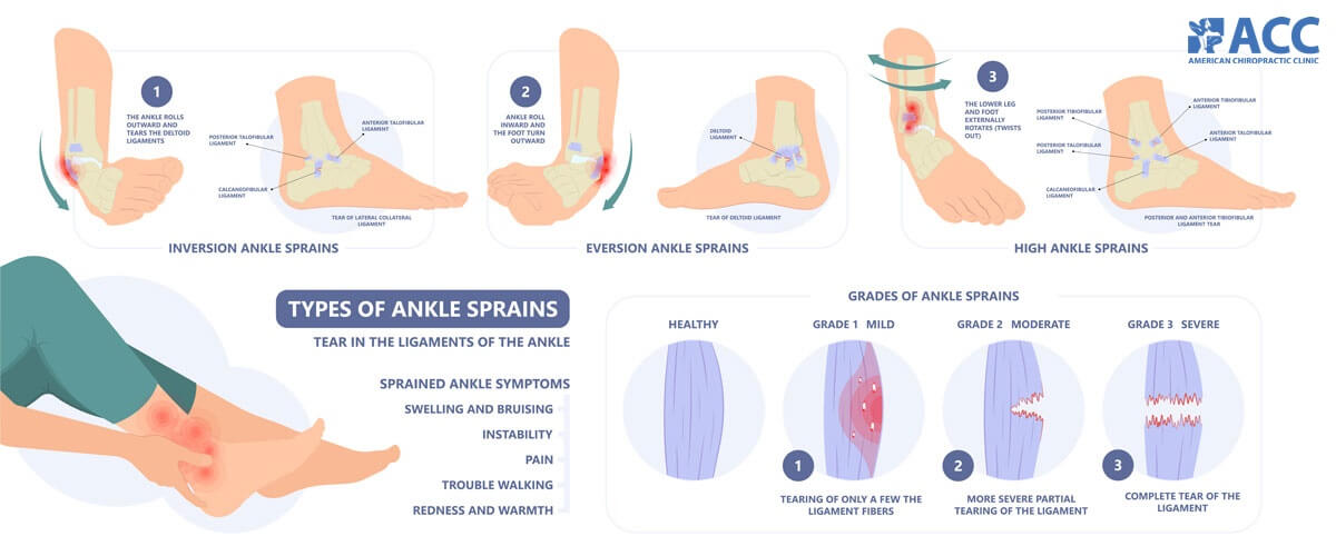 These Are The Five Effective Treatments for Ankle Sprain