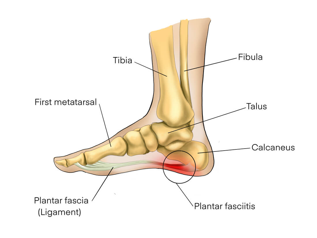 Heel Pain With Running – Best Treatment & Exercise For Plantar Fasciitis |  Central Performance