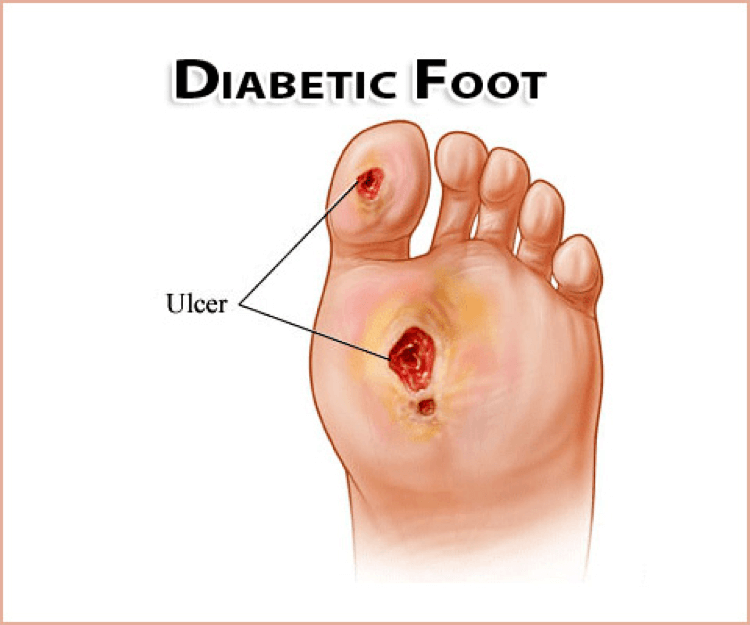 Common Foot Problems And How To Treat Acc