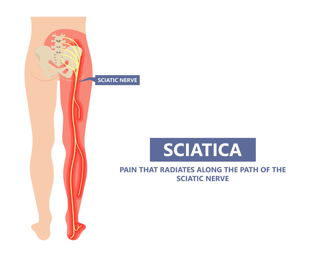 sciatic nerve pain