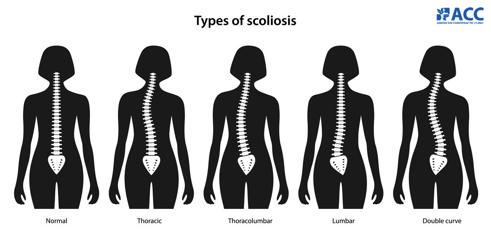 scoliosis types