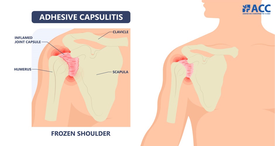 Shoulder pain: Common problems and Treatments