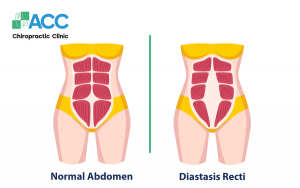 postpartum abdominal distention