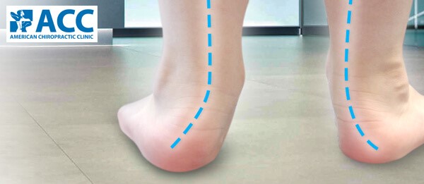 what is flat feet