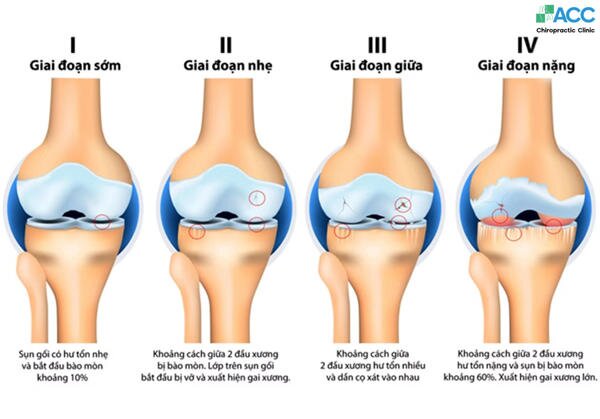 Knee Osteoarthritis