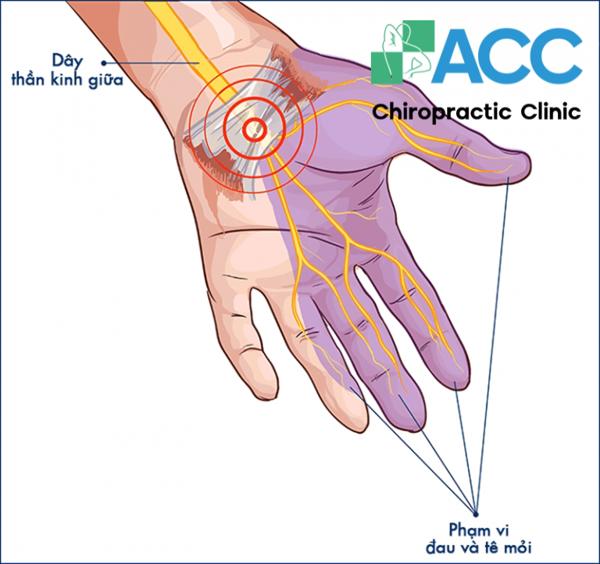 What is Carpal Tunnel syndrome