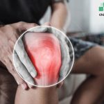 Rheumatoid Arthritis