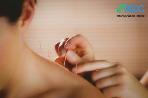 acupuncture neck shoulder pain guide