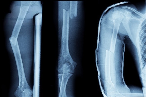 bicep pain causes and treatment