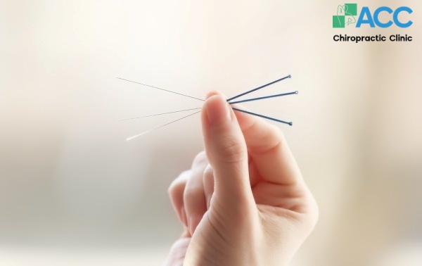 neck shoulder acupuncture methods