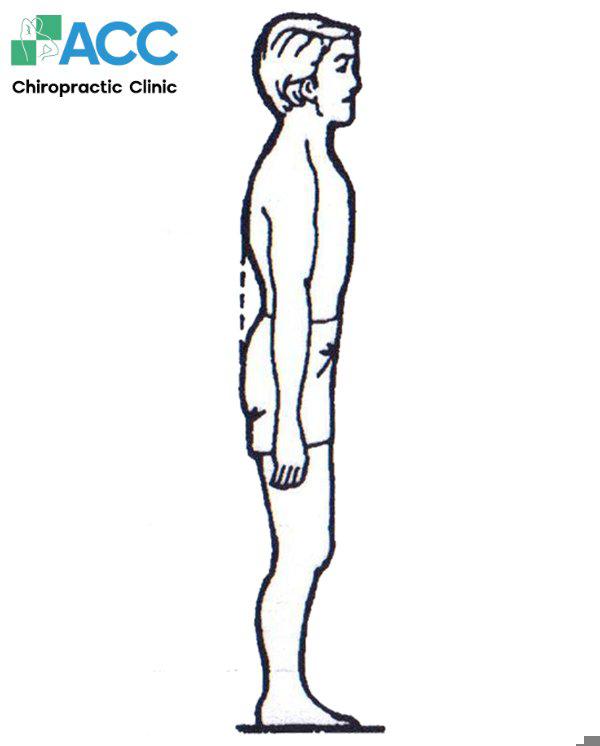 scoliosisn back exercises