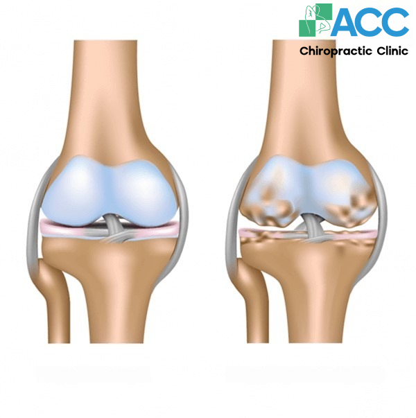 8 Risks of Knee Replacement Surgery That Not Everyone Knows