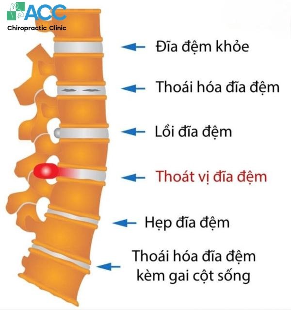 kidney disease back pain link