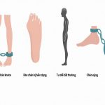 Knee Replacement Surgery