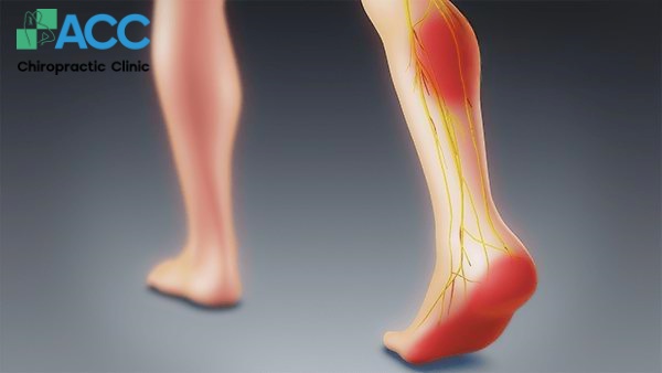 sciatica nerve root pain
