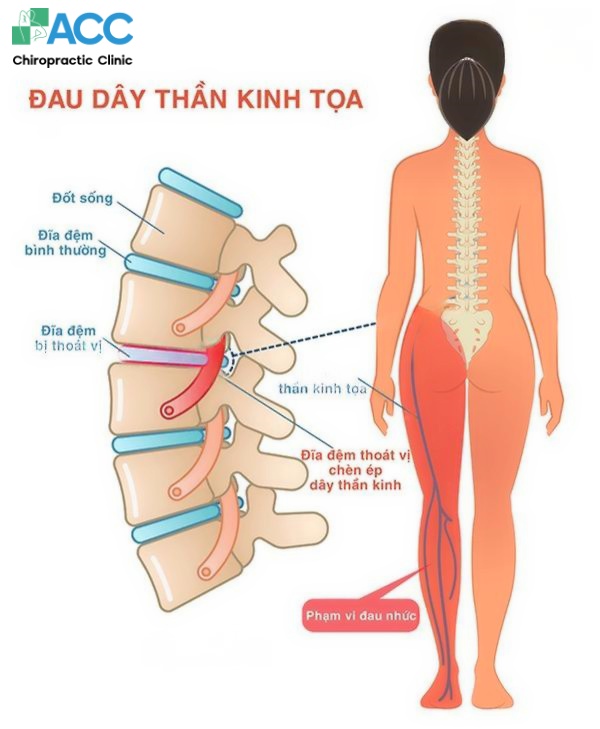 sciatica pain and symptoms