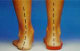 Flat or “crooked” feet, are a big cause of knee pain. Foot orthotics are often a big help.