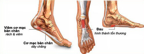 Đau Cơ Bàn Chân: Nguyên Nhân, Triệu Chứng và Cách Điều Trị Hiệu Quả