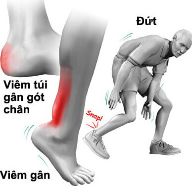 Đau chân phải là bệnh gì? Nguyên nhân, triệu chứng và cách điều trị hiệu quả