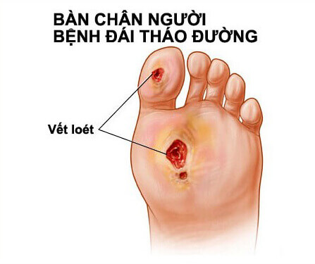 đau bàn chân do bệnh đái tháo đường