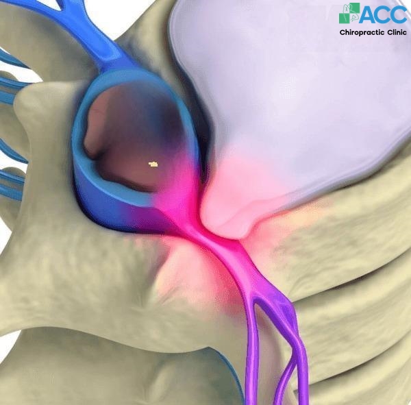 thoát vị đĩa đệm lưng
