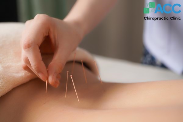 châm cứu chữa thoát vị đĩa đệm