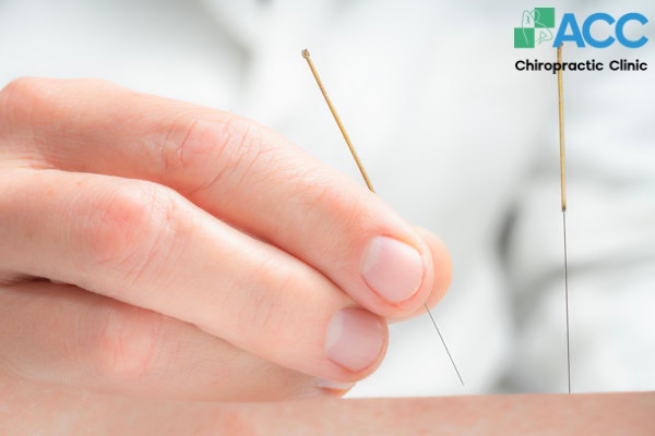 châm cứu thoát vị đĩa đệm