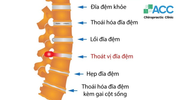 cột sống thắt lưng