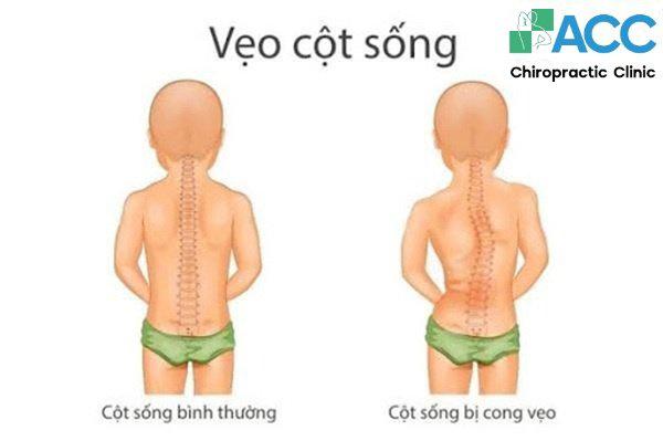 nắn chỉnh vẹo cột sống