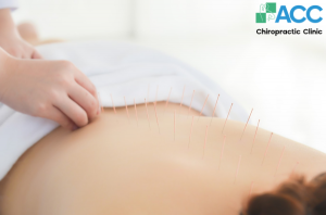 thuỷ châm chữa thoát vị đĩa đệm