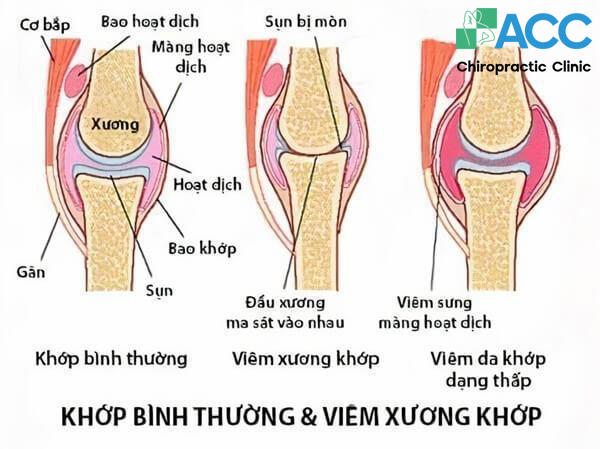 đau nhức gối