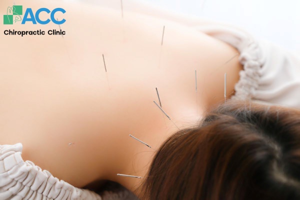 châm cứu đau vai gáy có hiệu quả không