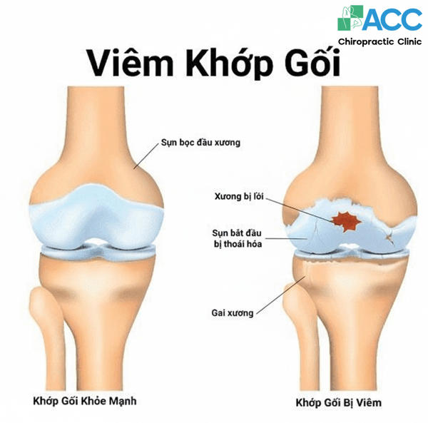 bệnh viêm đầu gối