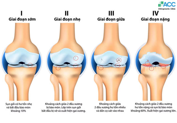 tiến triển của bệnh viêm đầu gối