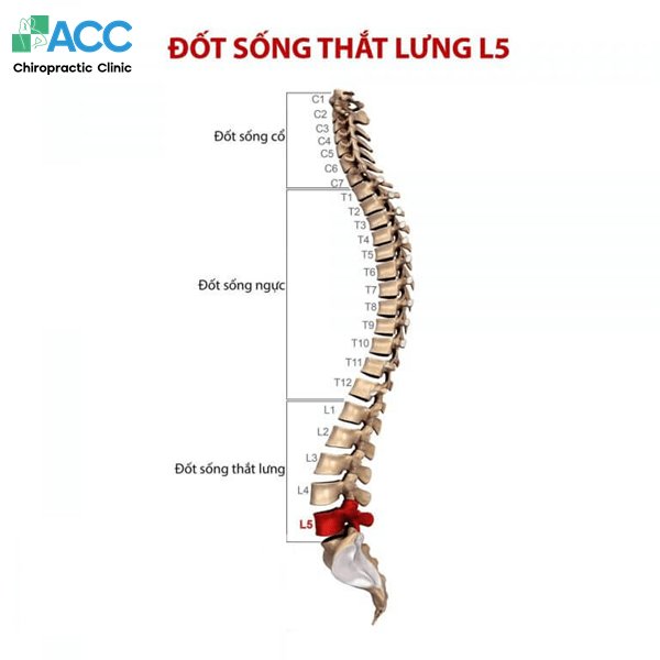 lồi đĩa đệm l5 s1