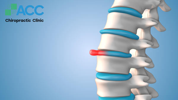 hình ảnh phồng đĩa đệm