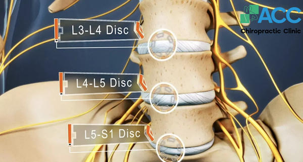 thoát vị đĩa đệm L4 L5