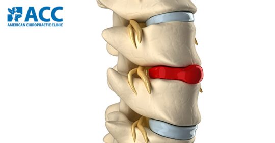 Lồi đĩa đệm có thể tự lành không?