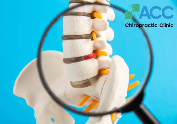 lồi đĩa đệm là gì