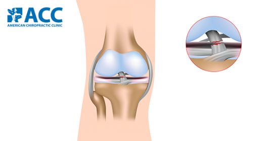 Nhận biết dấu hiệu đứt dây chằng chéo trước
