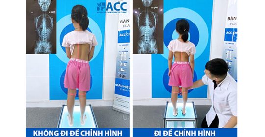 Mang lại nụ cười và cuộc sống bình thường cho bé gái mắc dị tật bàn chân