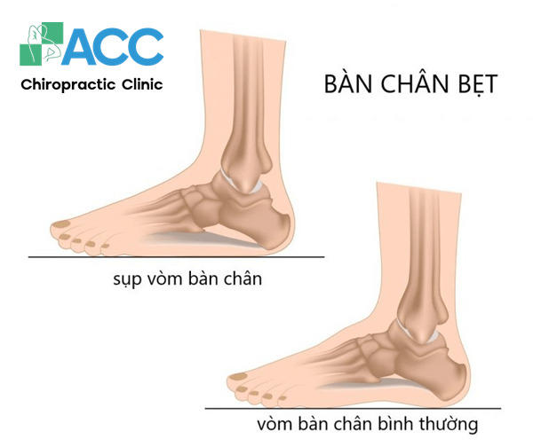 dấu hiệu bàn chân bẹt