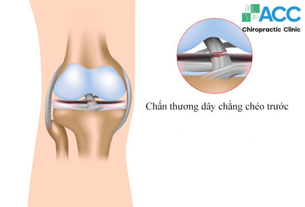 dây chằng chéo trước