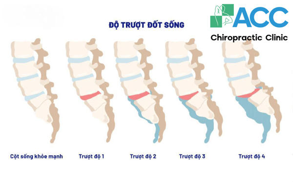 độ trượt đốt sống