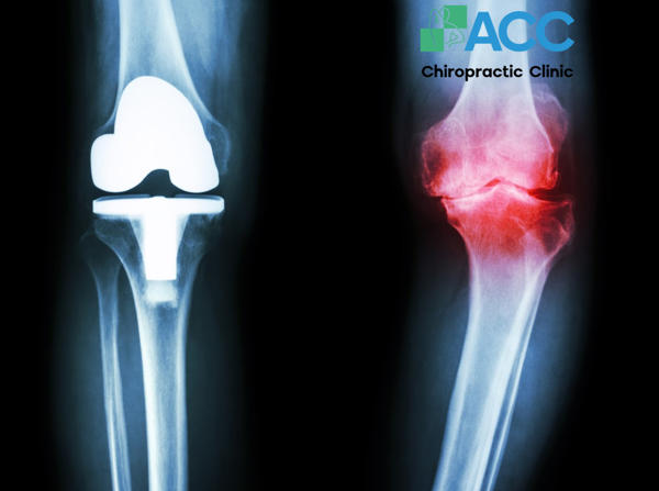 nội soi khớp gối